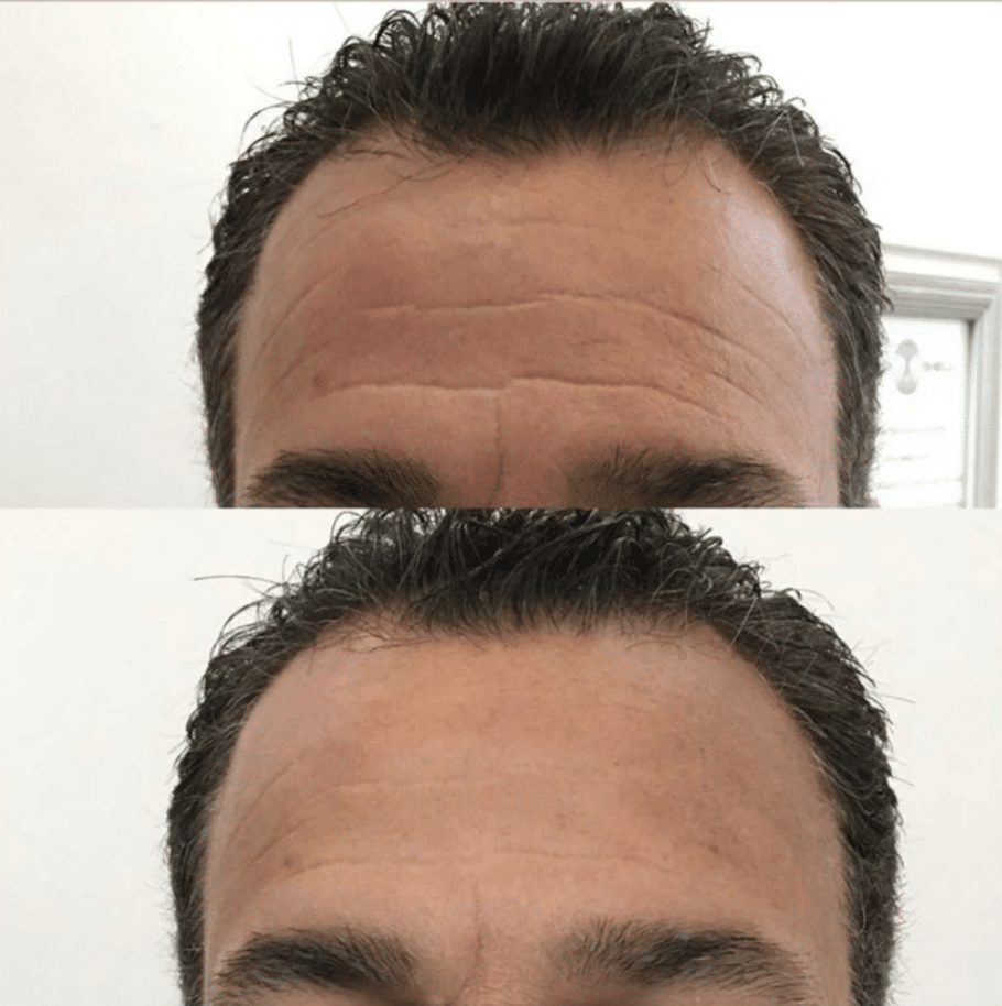 chillskin man forehead before after