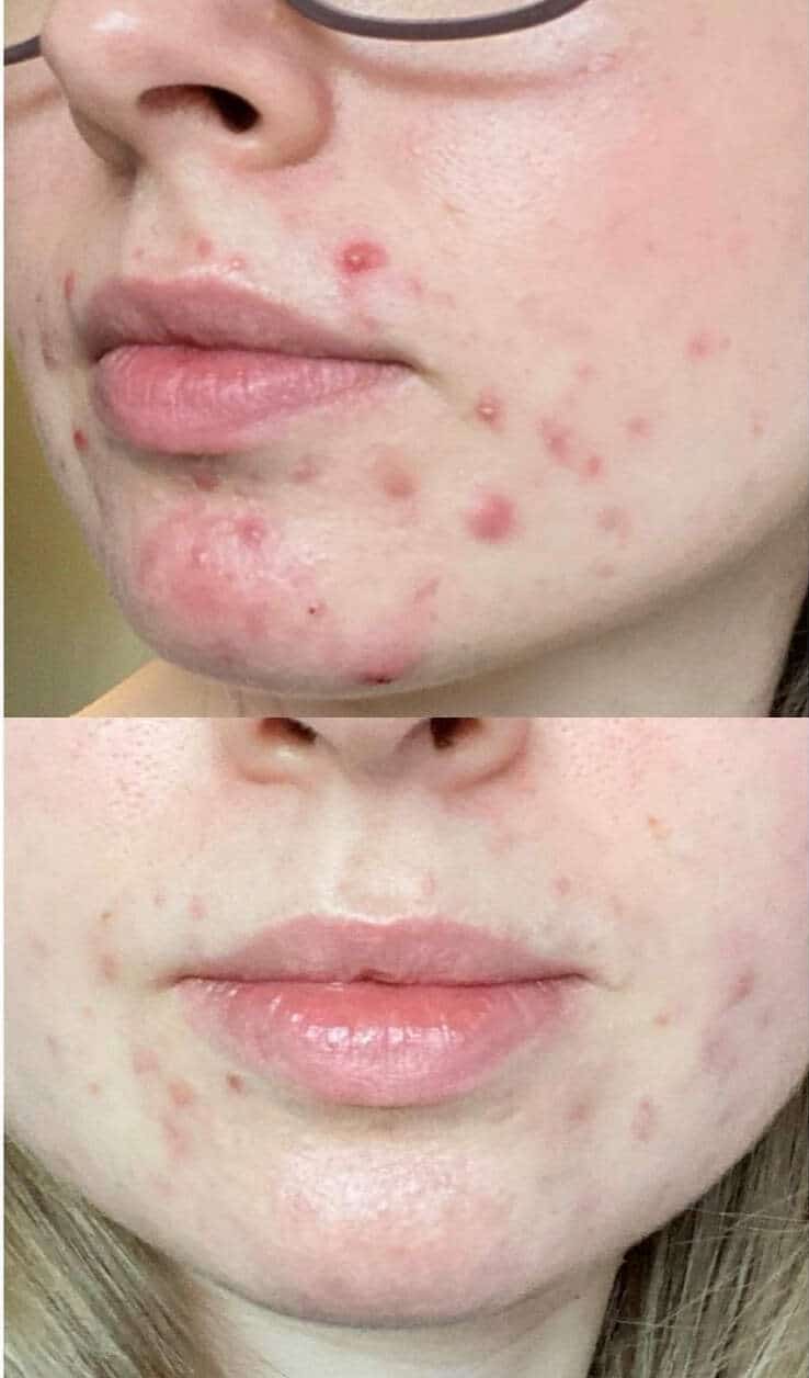 Before And After Bioptron Treatment Photo