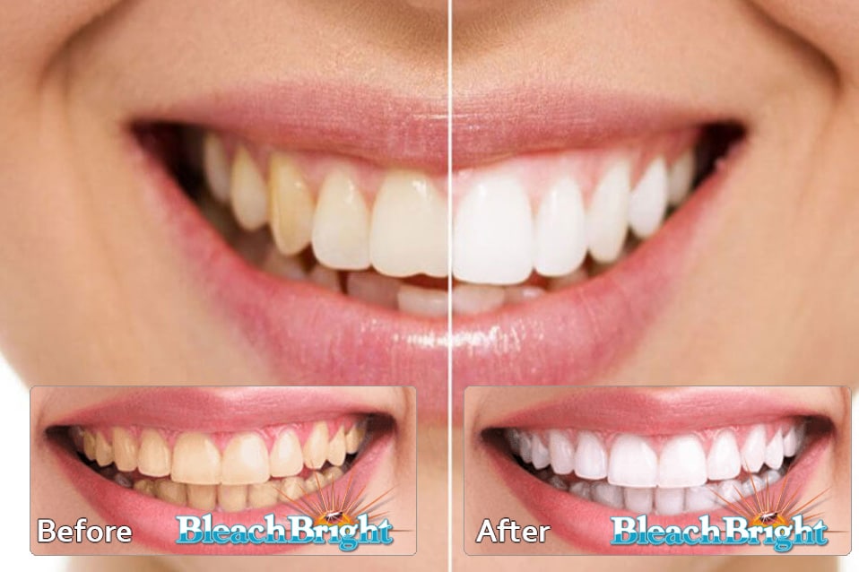 Bleach-Bright-Teeth-Whitening-Before-After-NJ