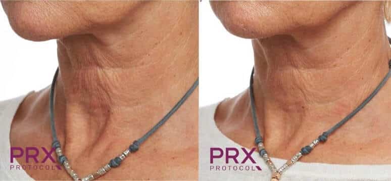 2 treatments