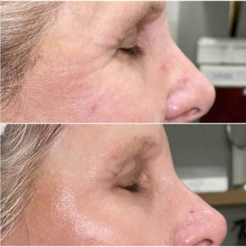 2 treatments