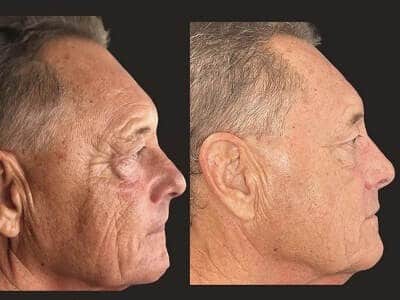 6 Treatments