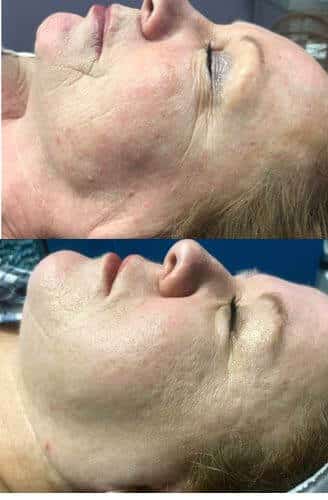 4 Treatments